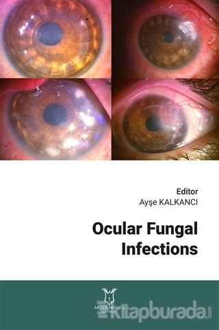 Ocular Fungal Infections Ayşe Kalkancı
